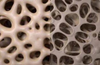 Osteoporosis Related Pain