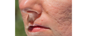 pimples